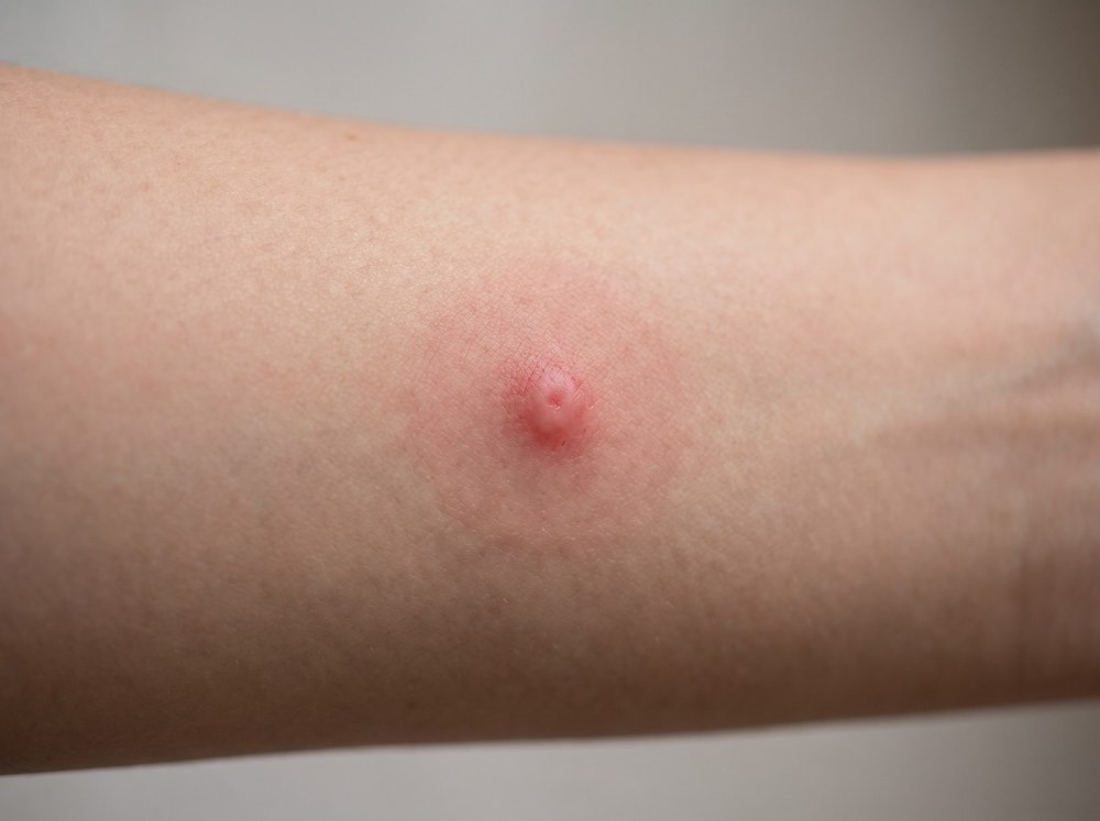 Close-up photograph of a fresh bumble bee sting on human skin showing a small raised red welt with mild swelling