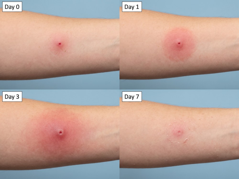 Side-by-side labeled comparison photograph of a bumble bee sting mark next to a honey bee sting mark and a wasp sting mark